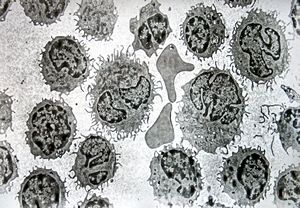 F,59y. | blood - hairy cell leukemia F,59y. | blood - hairy cell leukemia